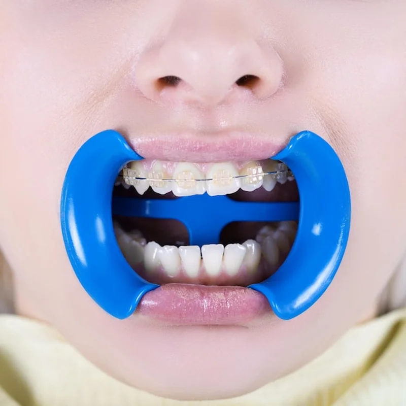 Remineralizacja szkliwa – co to jest i jak wpływa na zęby?